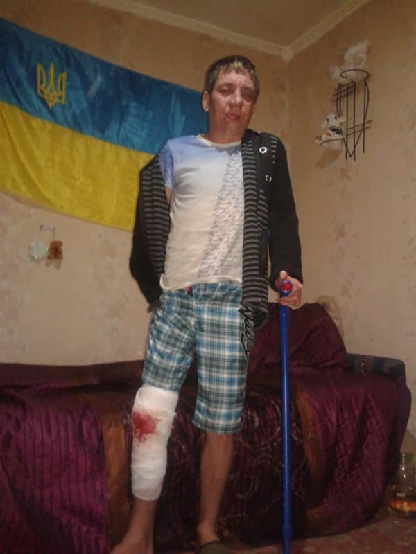 Нужна помощь мужчине с лицом Фредди Крюгера – новости Днепра