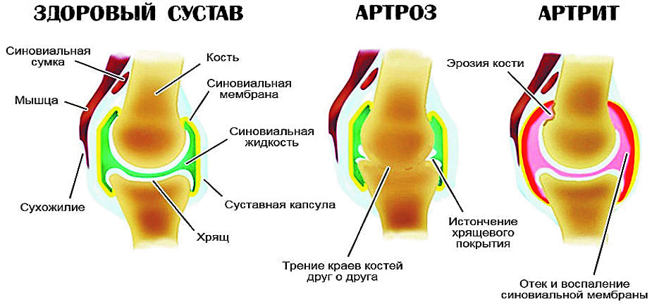 Дети стали чаще болеть артритом  – новости Днепра