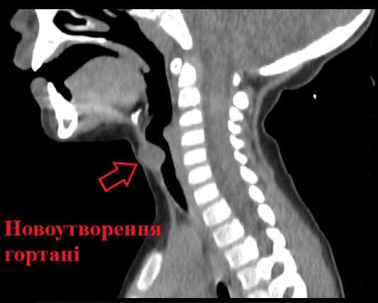 Спасли ребенка с огромным новообразование гортани - новости Днепра